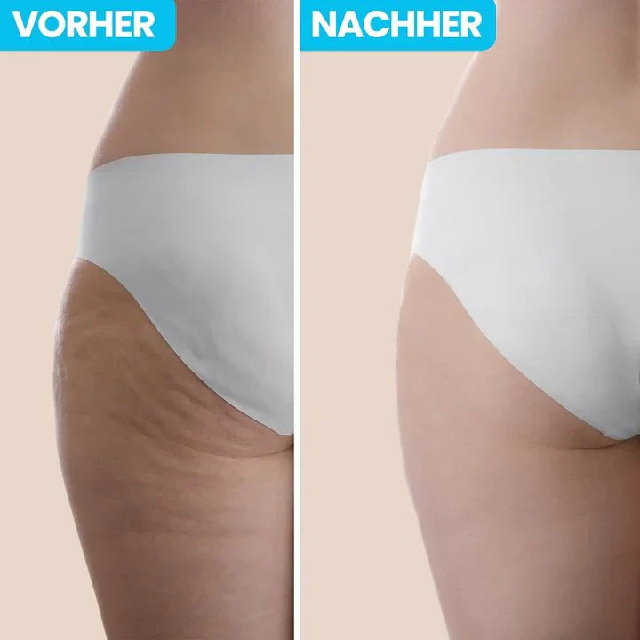 60% de descuento | CelluPro™️ ¡Elimina la celulitis desde la comodidad de tu hogar!