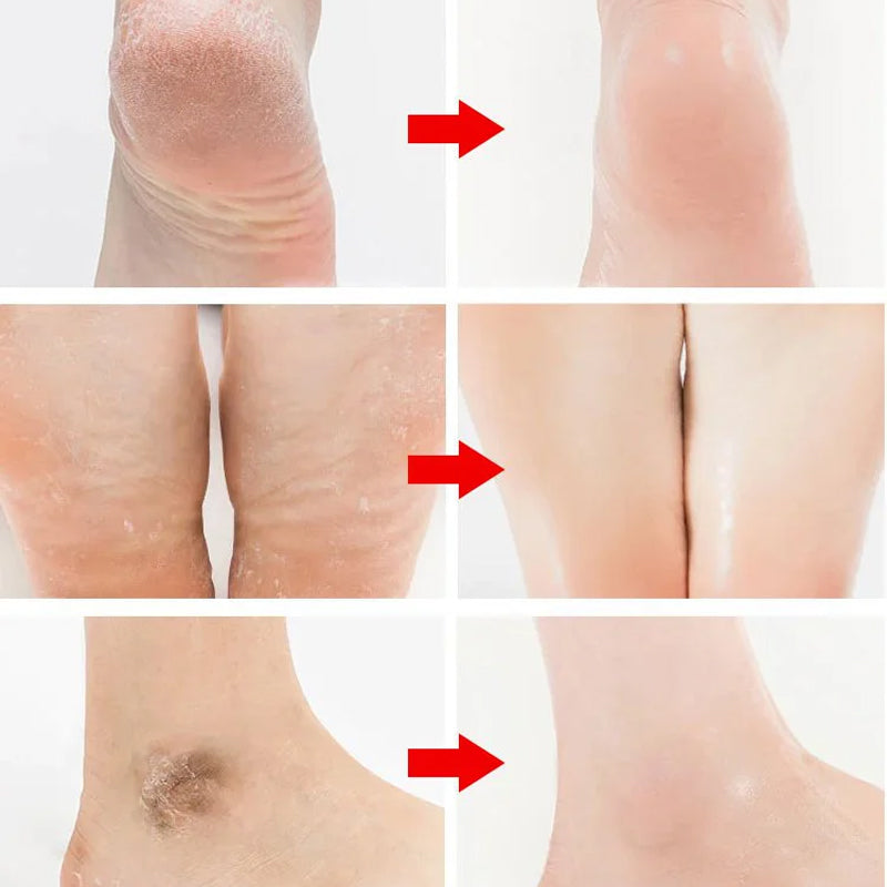 Gluschwein - Rechargeable electric foot callus remover