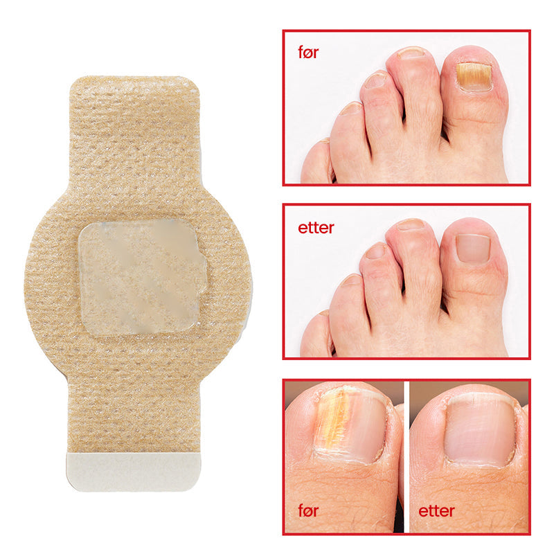 1+1 Gratuit | Nailox | Traitement efficace contre la mycose des ongles