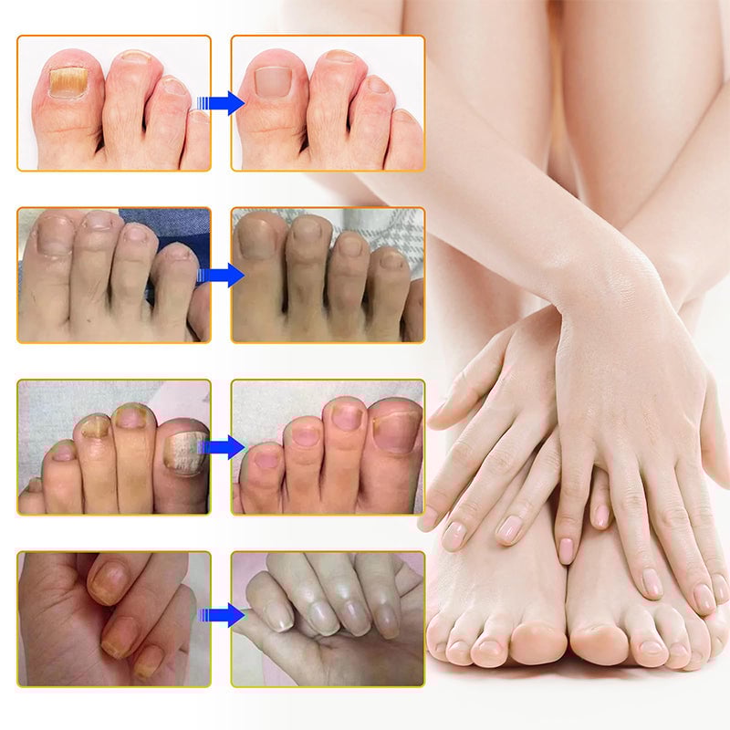 1+1 Gratuit | Nailox | Traitement efficace contre la mycose des ongles