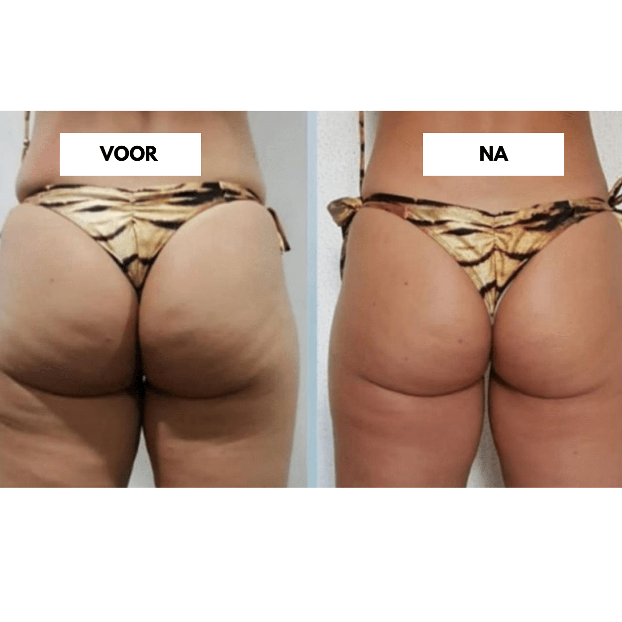 Appareil anti-cellulite CelluCare