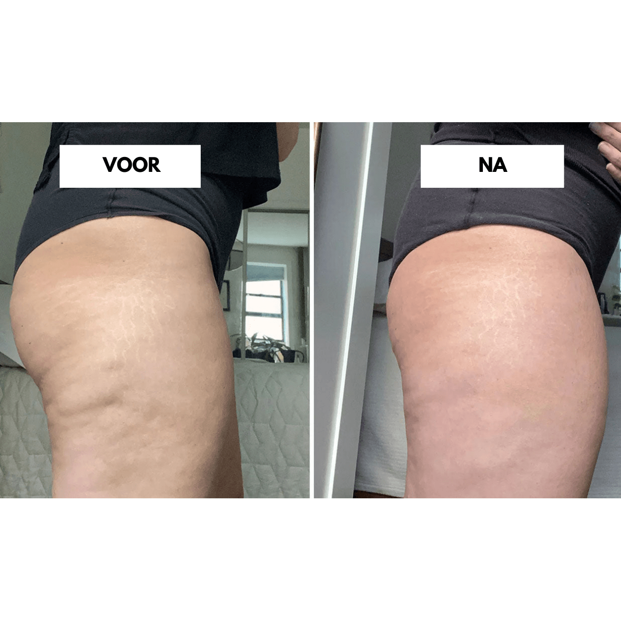 Appareil anti-cellulite CelluCare