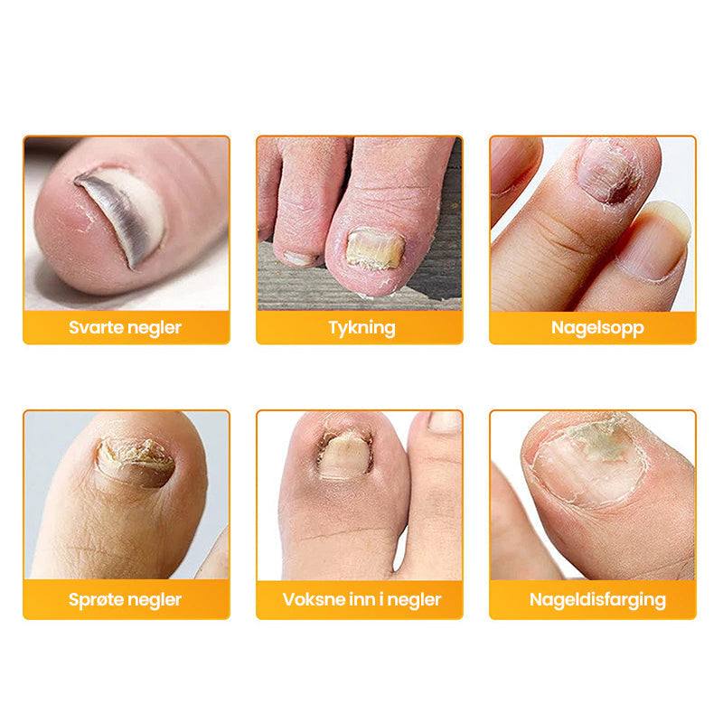 1+1 Gratuit | Nailox | Traitement efficace contre la mycose des ongles
