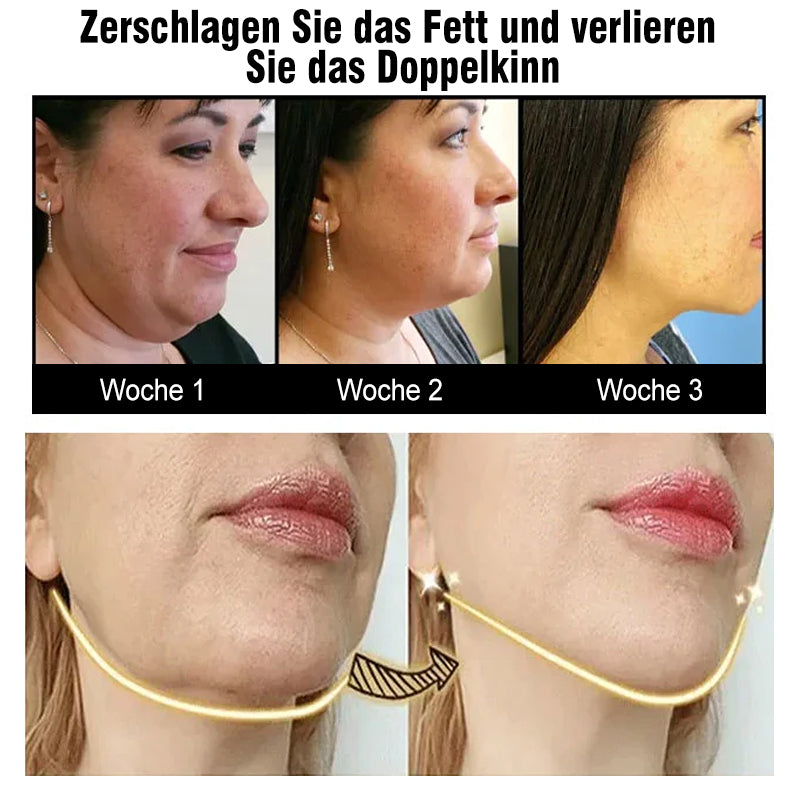 Gluschwein - V-förmiges Facelifting-Instrument